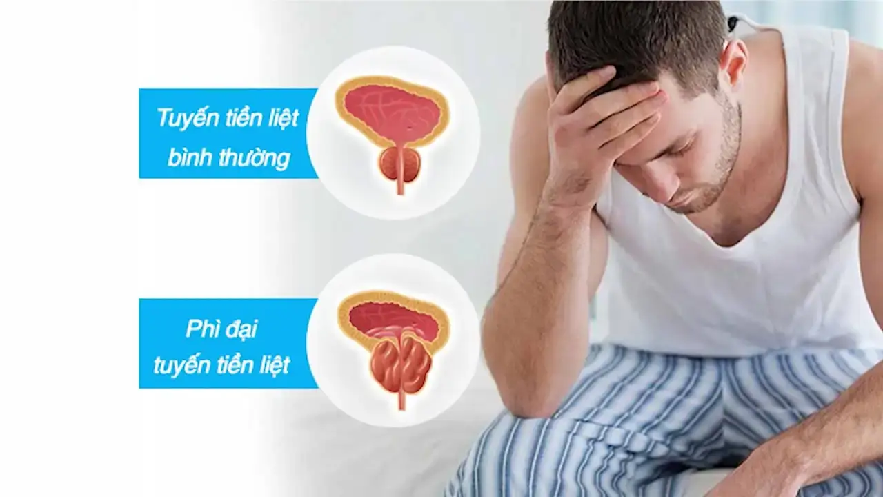 Tuyến tiền liệt là gì và vai trò đối với cơ thể nam giới